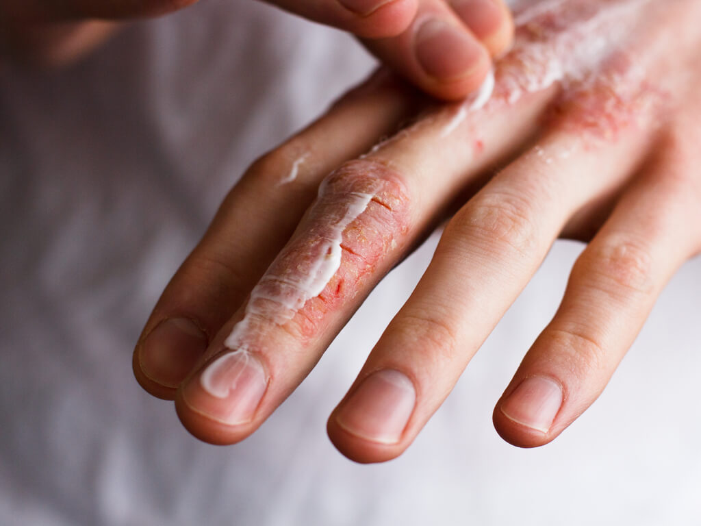 Applying cold cream to eczema can reduce swelling and itchiness. Call Tennessee Telederm for more help dealing with eczema this winter.