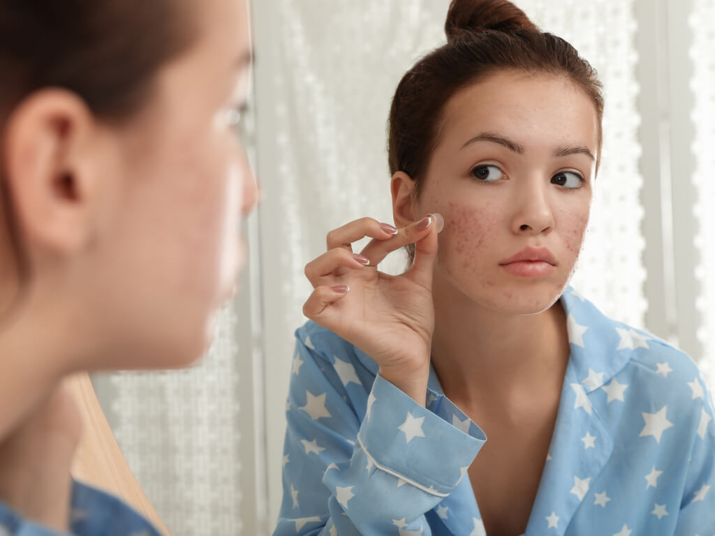 Acne information and tips from online dermatology business, Tennessee Telederm