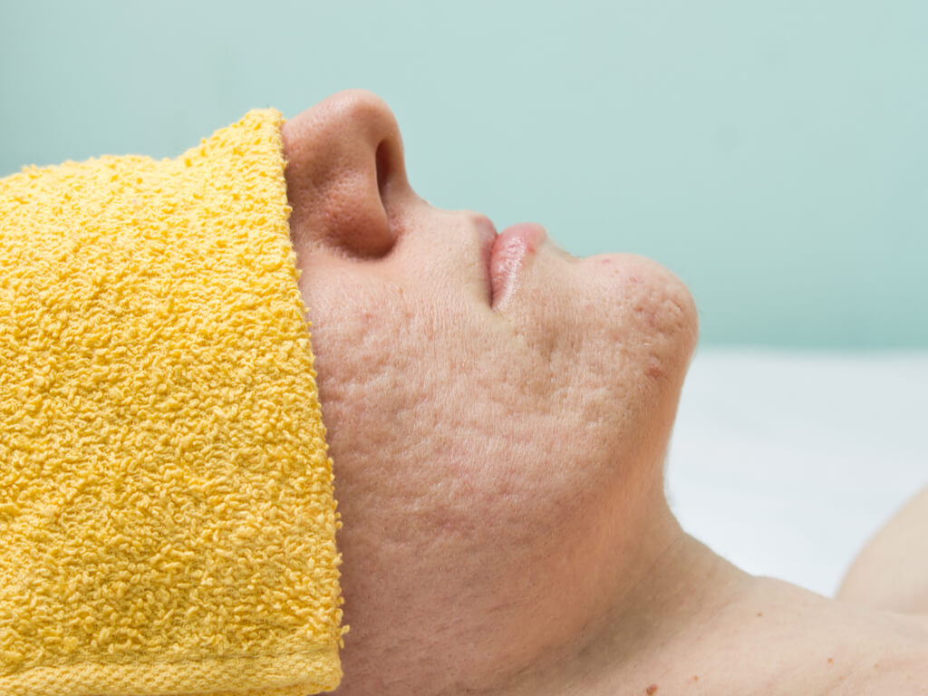 Dealing with acne scars in TN