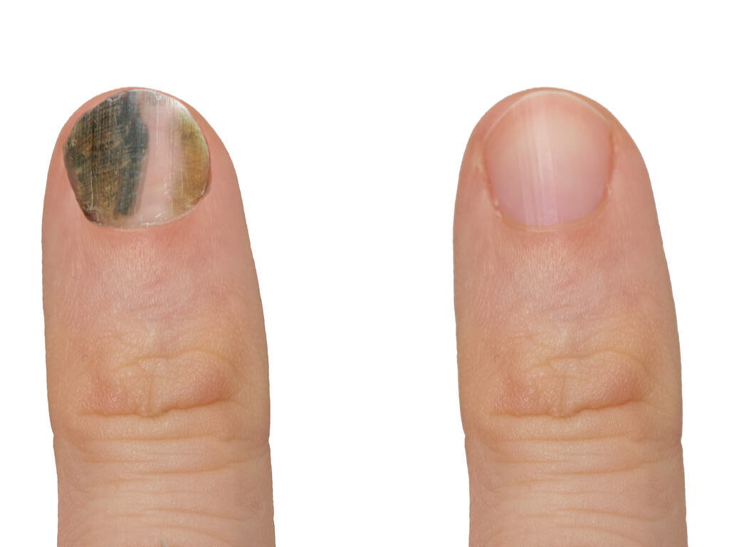 Nail bacterial infection.