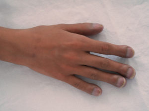 An example of clubbed nails.