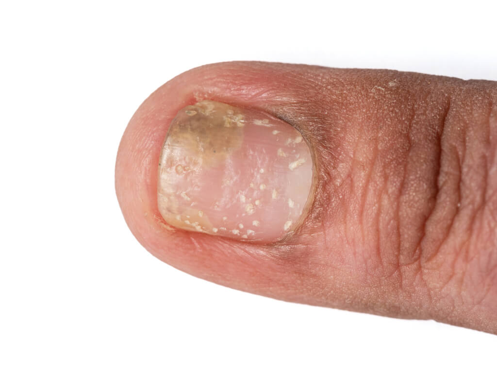 Treat nail discoloration with Tennessee Telederm