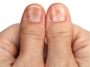 Ridge fingernails