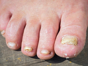 Toenail fungus can look like a yellow-white growth that makes the nails deteriorate.