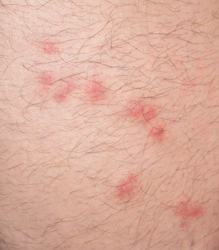 Flea bites are small red dots on the skin.