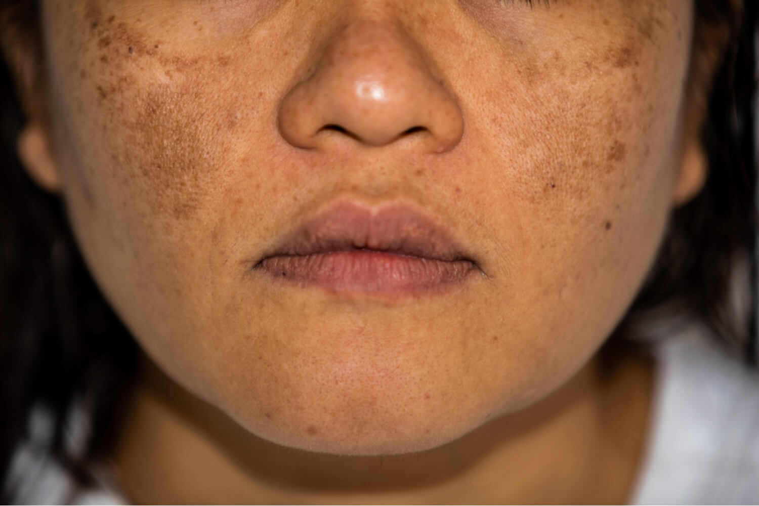 hyperpigmentation caused by acne