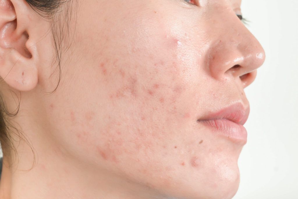 Physical acne scars are caused by collagen buildup