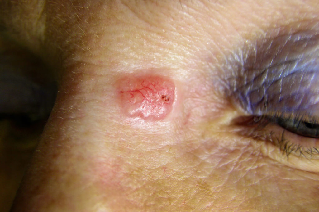 Basal cell carcinoma tumor on the bridge of a woman's nose