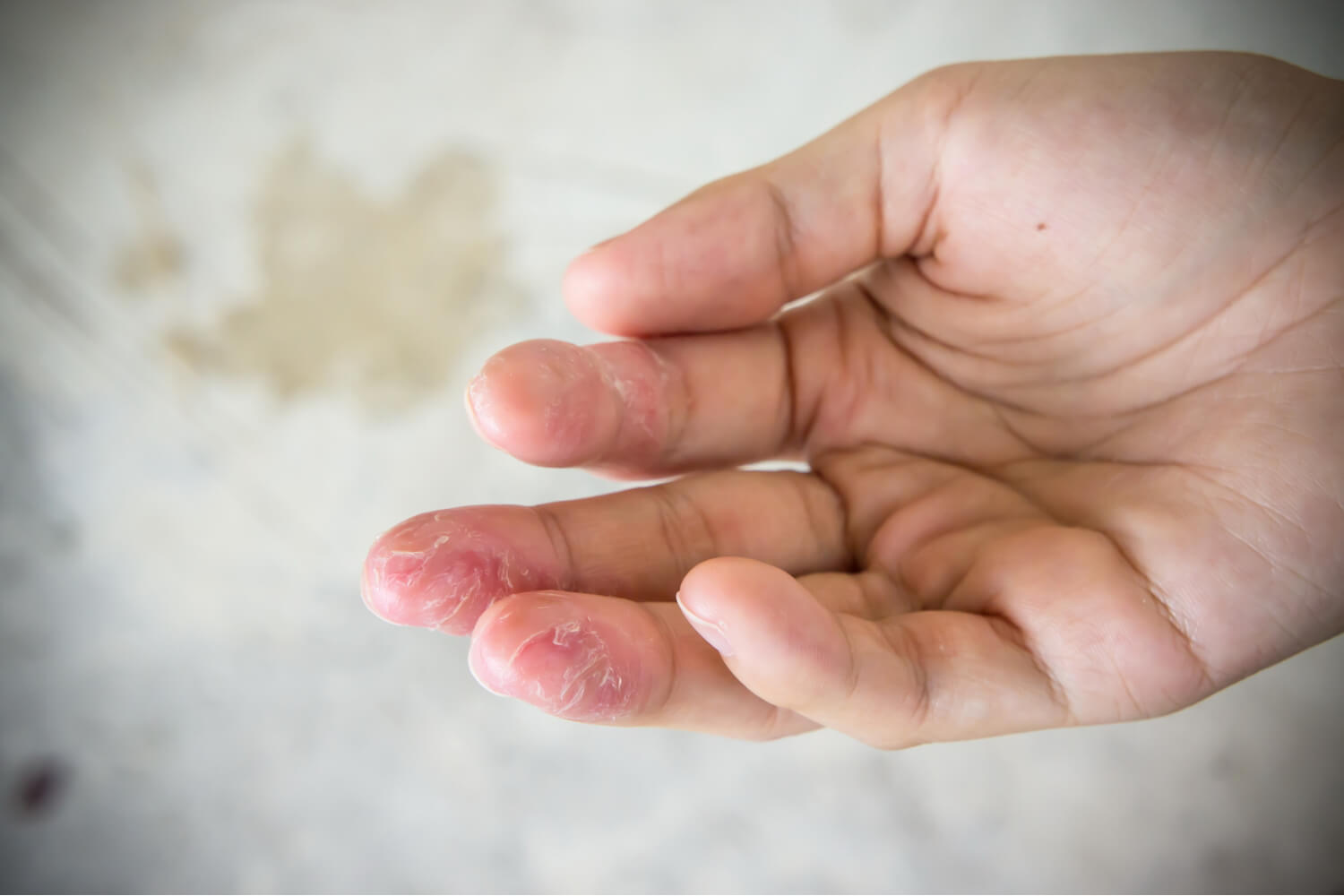 Contact dermatitis causes itching and peeling of skin after repeated contact with an irritant