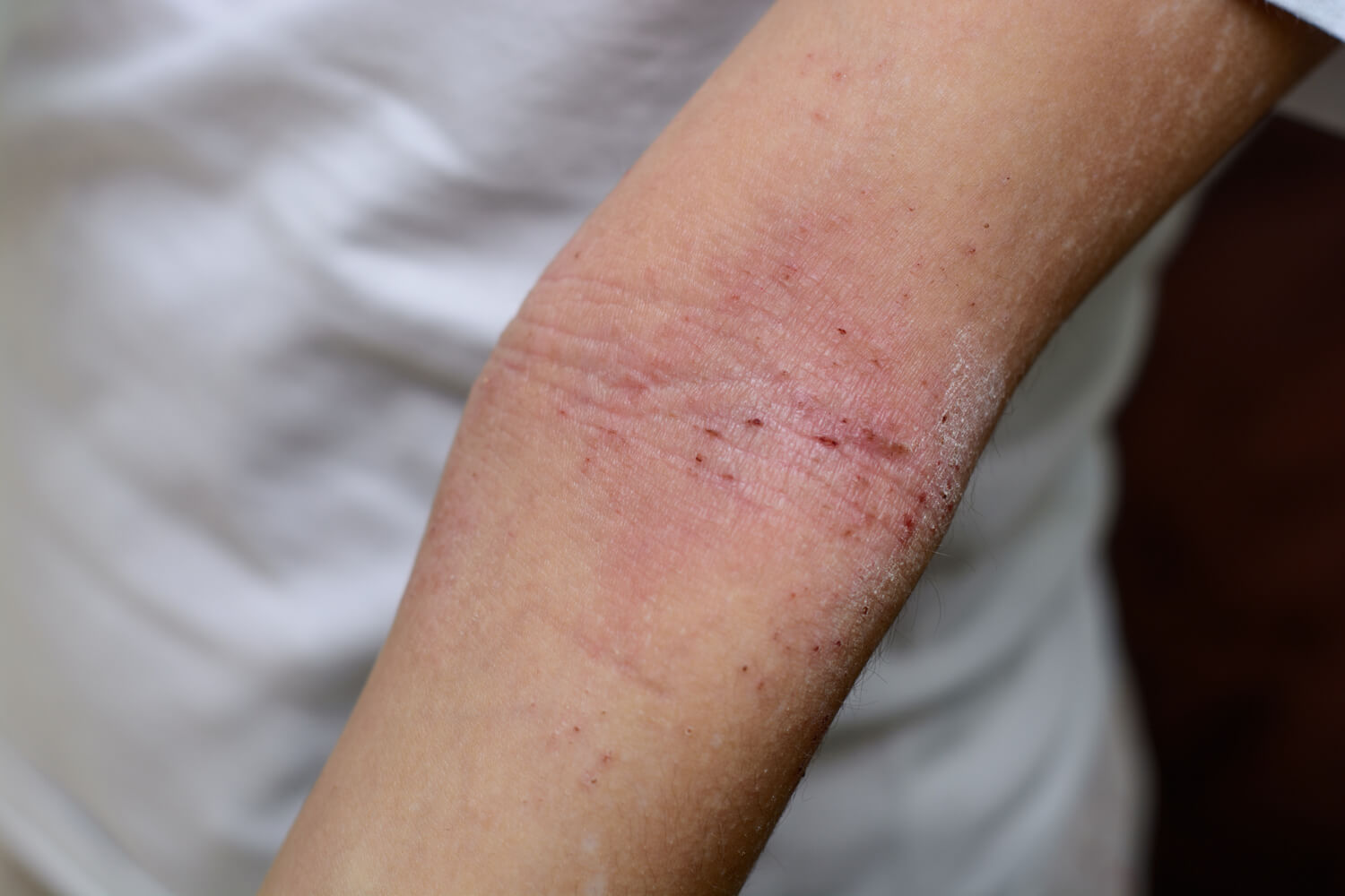 A person's inner elbow showing signs of an eczema rash