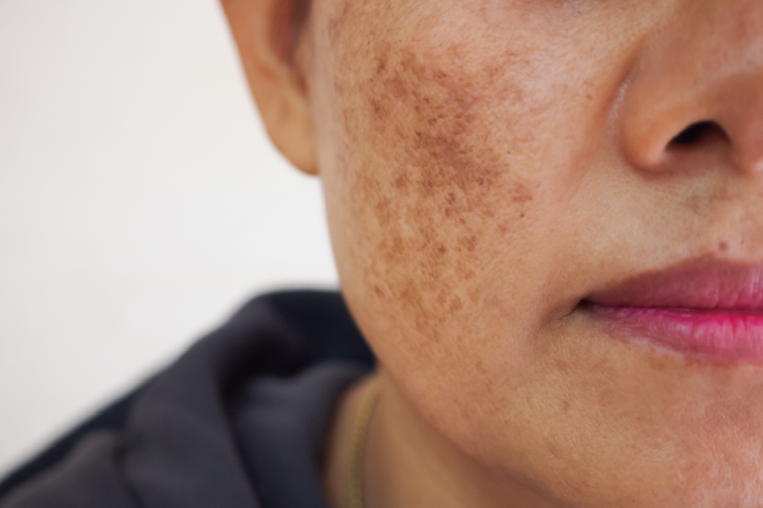 Melasma is a discoloration of the mid-face that looks like darker patches of skin