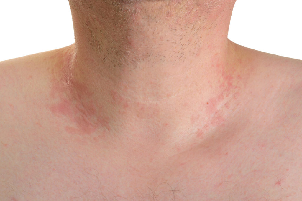 Poikiloderma is discoloration of the thin skin around the neck due to sun damage