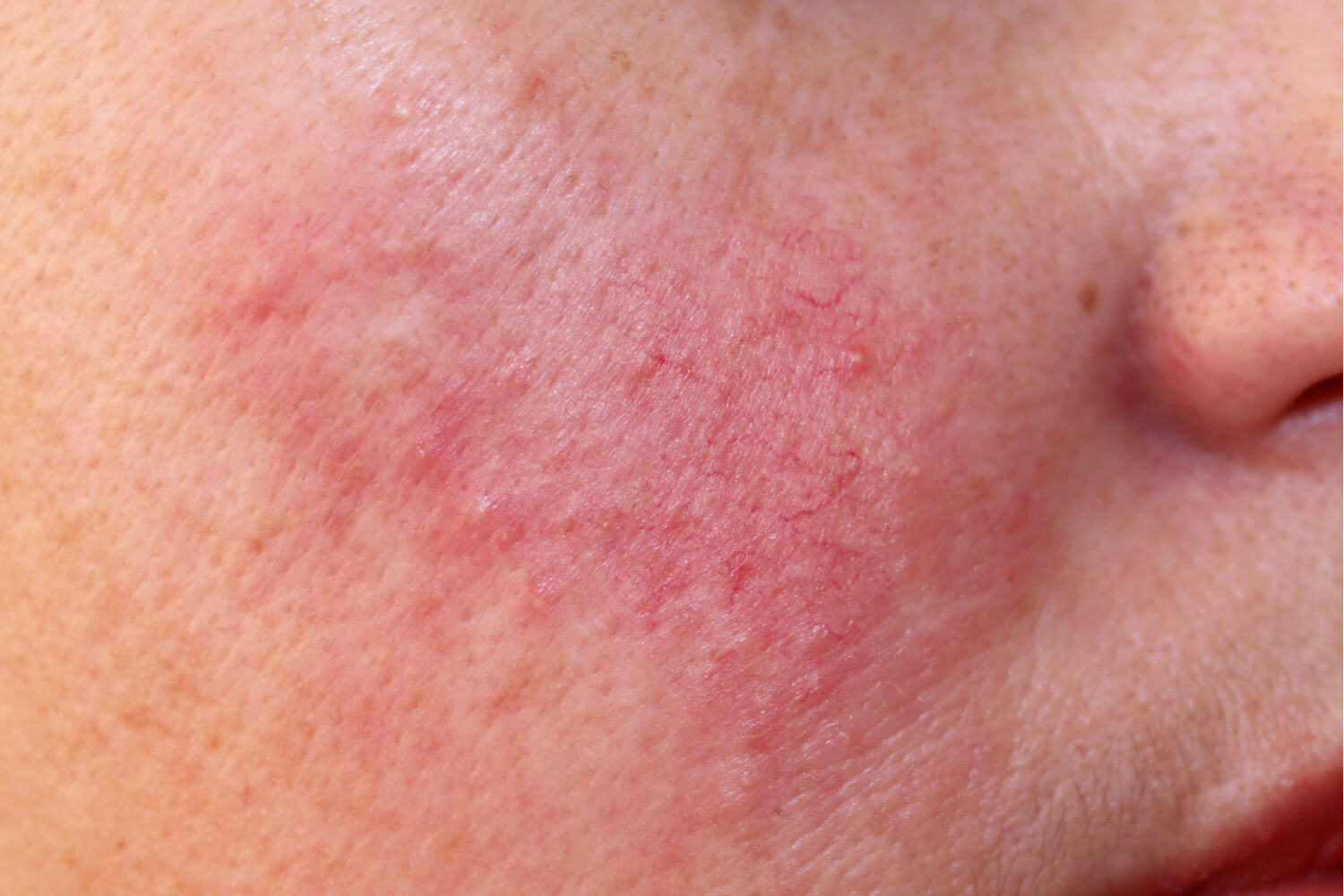 Rosacea is a non-acne causing reddness in the face