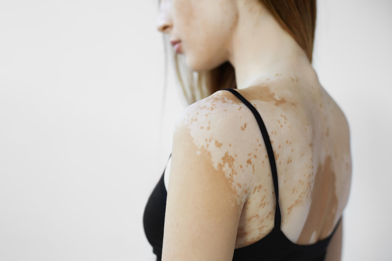 Woman with discolored skin on her back caused by vitiligo
