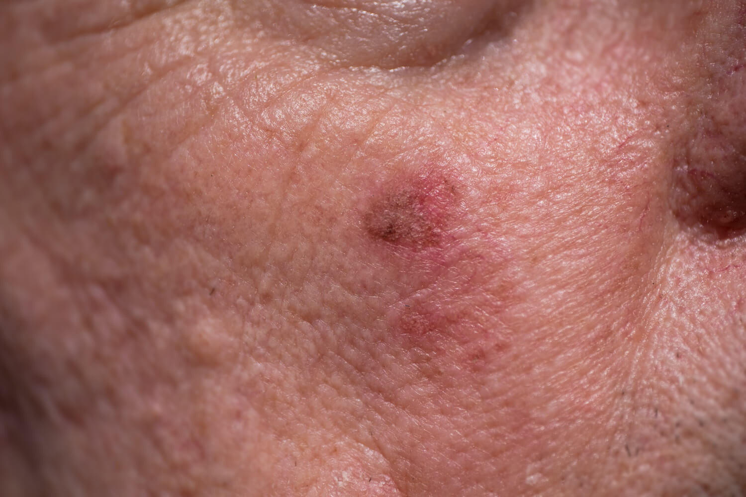 Types Of Skin Discoloration And Scarring In Dermatology Tennessee