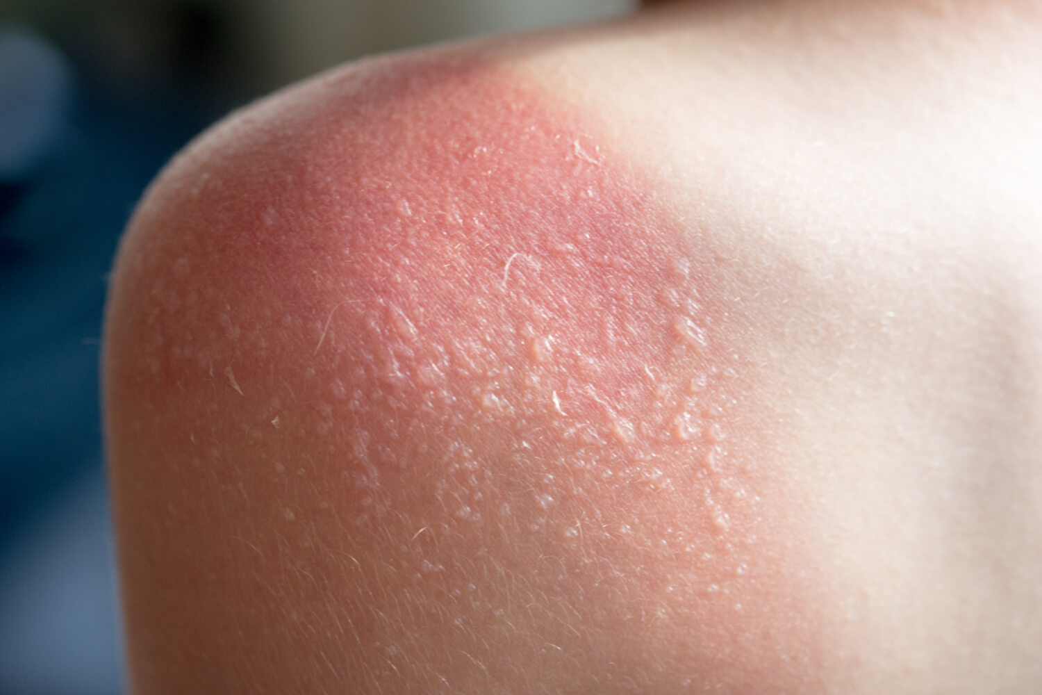 Sunburns appear as hot red patches of skin after extended sun exposure