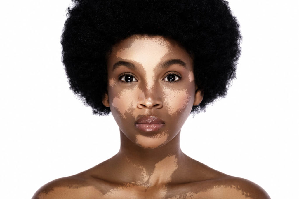 Vitiligo symptoms show up as light discolored patches of skin due to a reduced amount of melanin pigments in the skin.