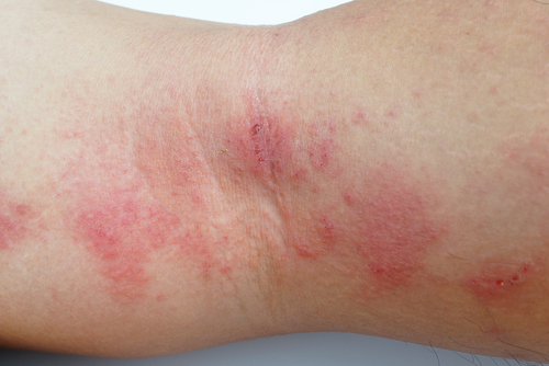 Treat an itchy eczema rash with online dermatology in Tennessee.