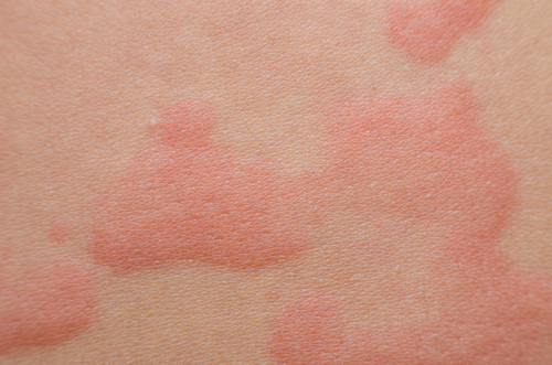 Treat an itchy hives skin rash