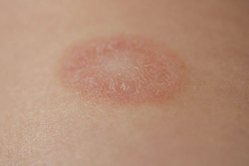 Pityriasis Rosea itchy rash - treat with online dermatology in Tennessee