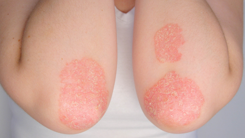 Psoriasis flare up - itchy skin condition