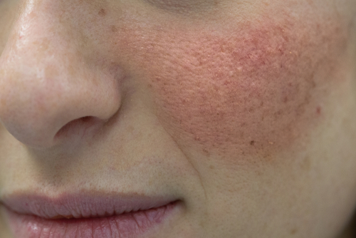 Seborrheic Dermatitis on woman's cheek - Get treatment in Tennessee