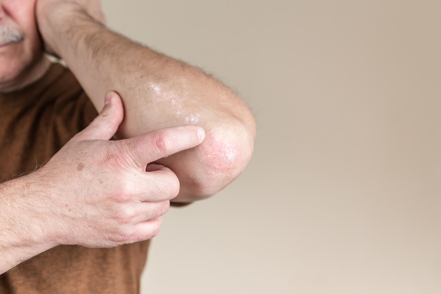 Chronic dermatitis on the elbow presents like psoriasis with flaky scales, white patches, redness, and inflammation