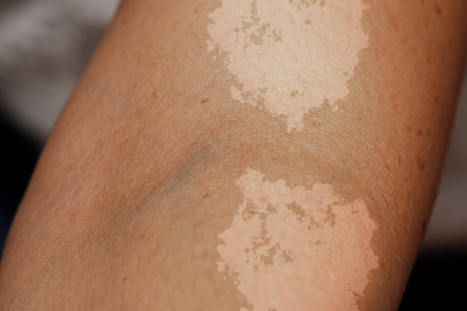 Tinea versicolor is a fungal infection that presents as a white, discolored patch of skin.