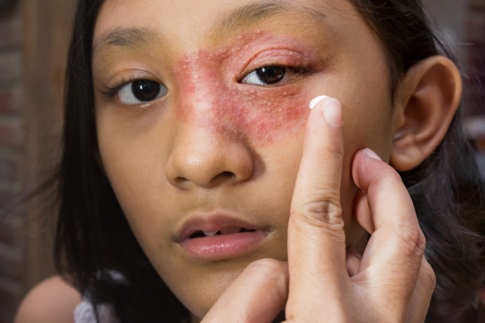 Eczema in teen, treat eczema online